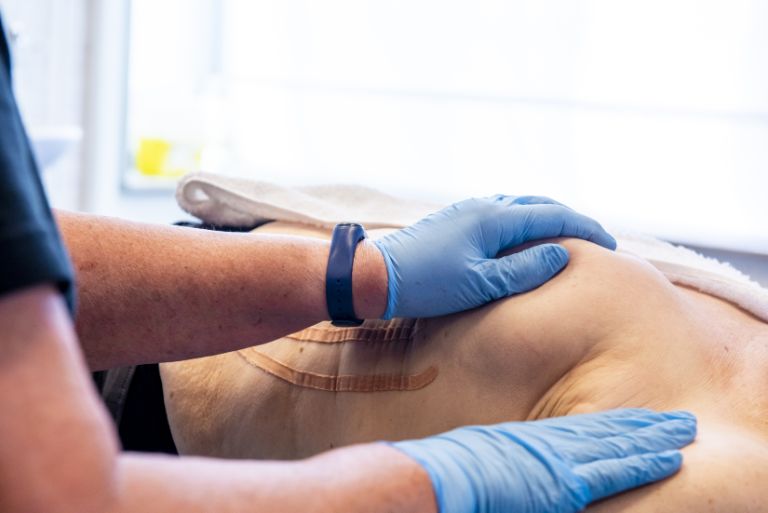 Dry needling